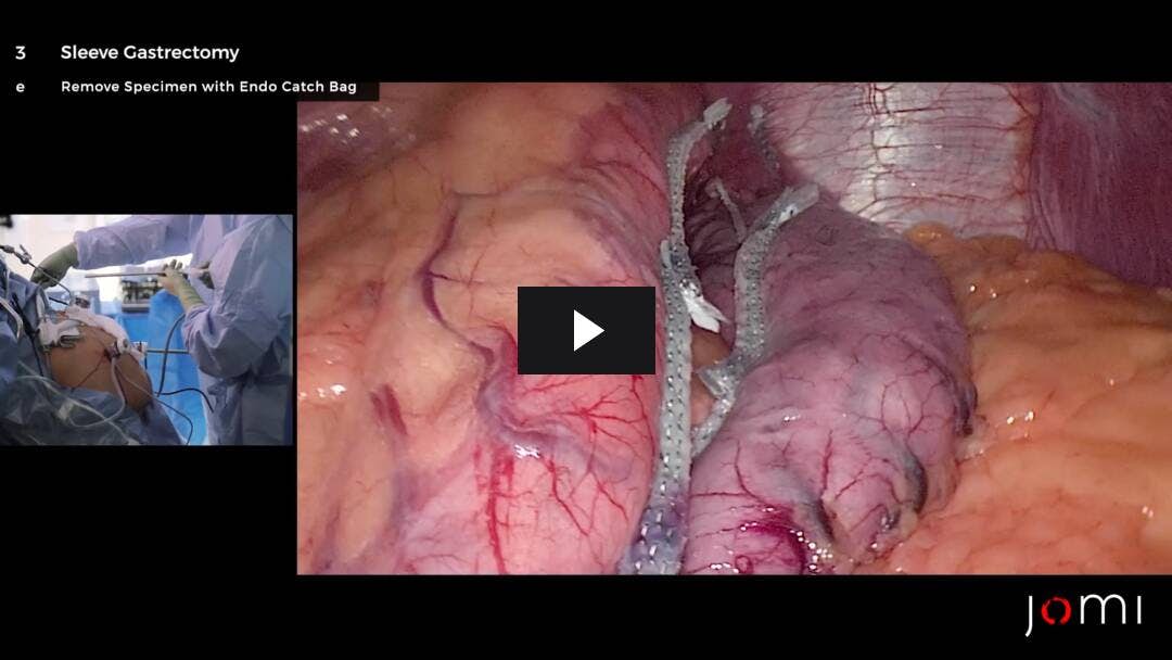 Video preload image for Gastrectomía laparoscópica en manga
