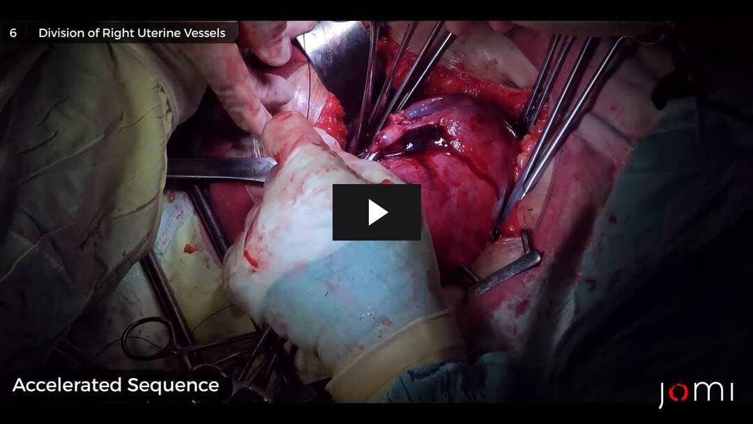 Video preload image for 큰 자궁 근종에서 외과 적 접근으로서의 복부 자궁 적출술