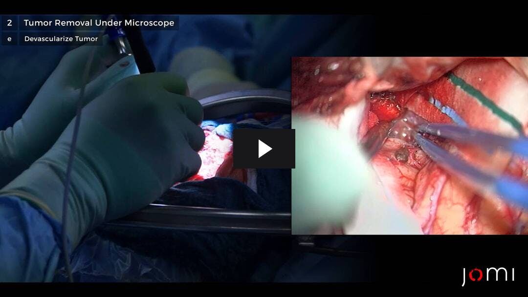 Video preload image for Resection of a Sphenoid Wing Meningioma