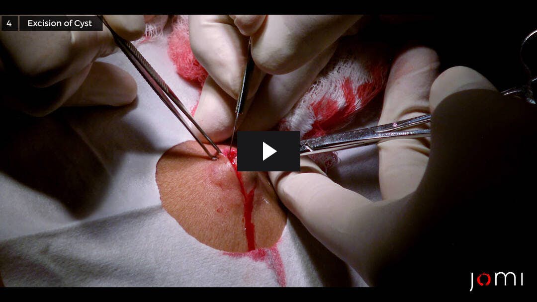 Video preload image for Escisión del quiste de inclusión epidérmica