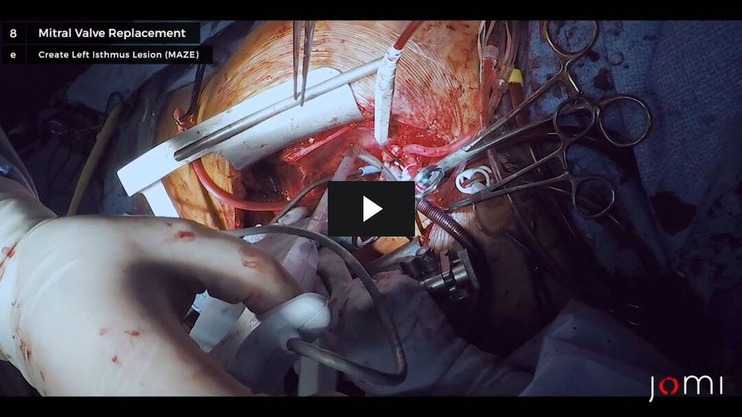 Video preload image for Cox-MAZE IV with Coronary Artery Bypass Graft (CABG) and Mitral Valve Replacement (MVR)