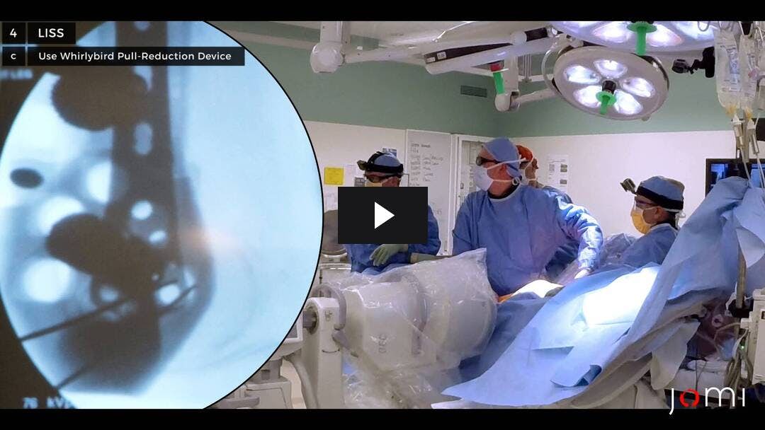 Video preload image for Less Invasive Stabilization System (LISS) for Distal Femur Fracture Repair