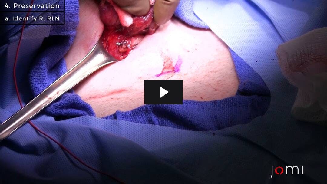 Video preload image for Right Hemithyroidectomy