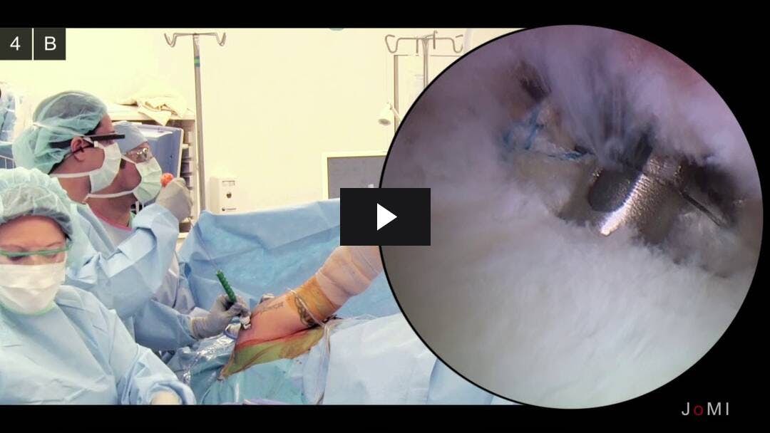 Video preload image for Arthroskopische Reparatur des hinteren Labralrisses mit paralabraler Zystendekompression