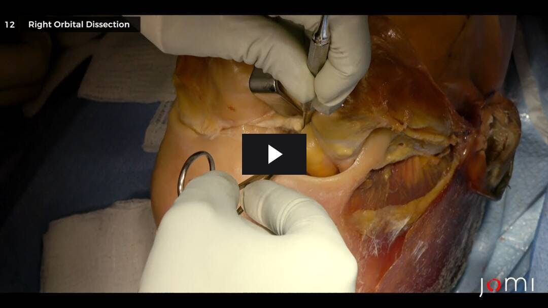 Video preload image for Coronal Approach (Cadaver)