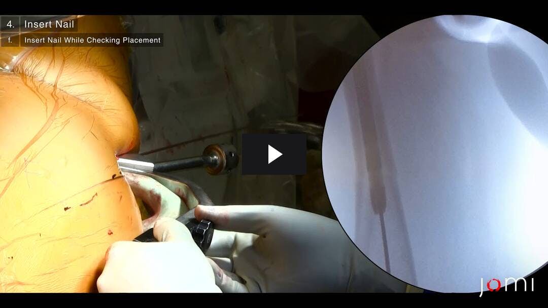 Video preload image for Closed Cephalomedullary Nailing of a Diaphyseal Femur Fracture on a Fracture Table