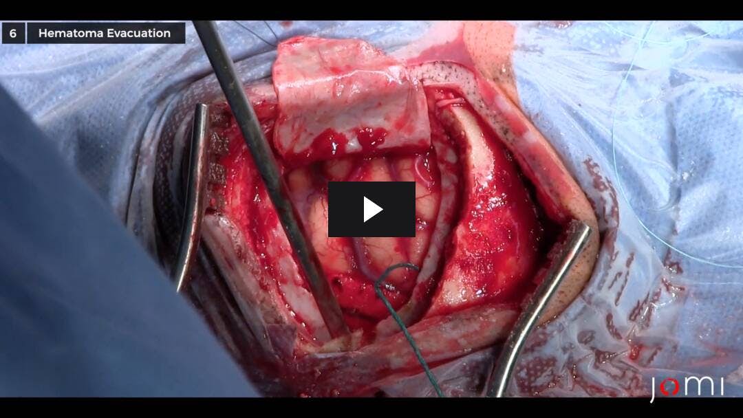 Video preload image for Evacuación del hematoma subdural agudo