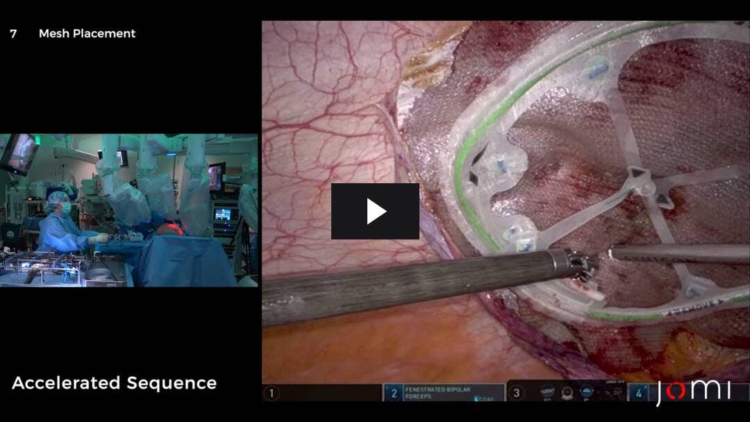 Video preload image for Robotic-Assisted Laparoscopic (rTAPP) Umbilical Hernia Repair with Intra-abdominal Preperitoneal Underlay Mesh (IPUM)