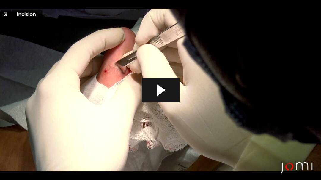 Video preload image for Drainage der zystischen Masse am ersten linken Zeh