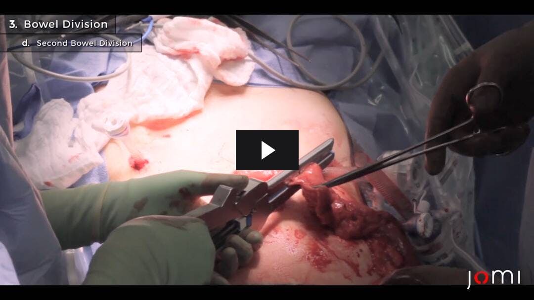 Video preload image for Laparoscopic Sigmoid Resection for Diverticulitis