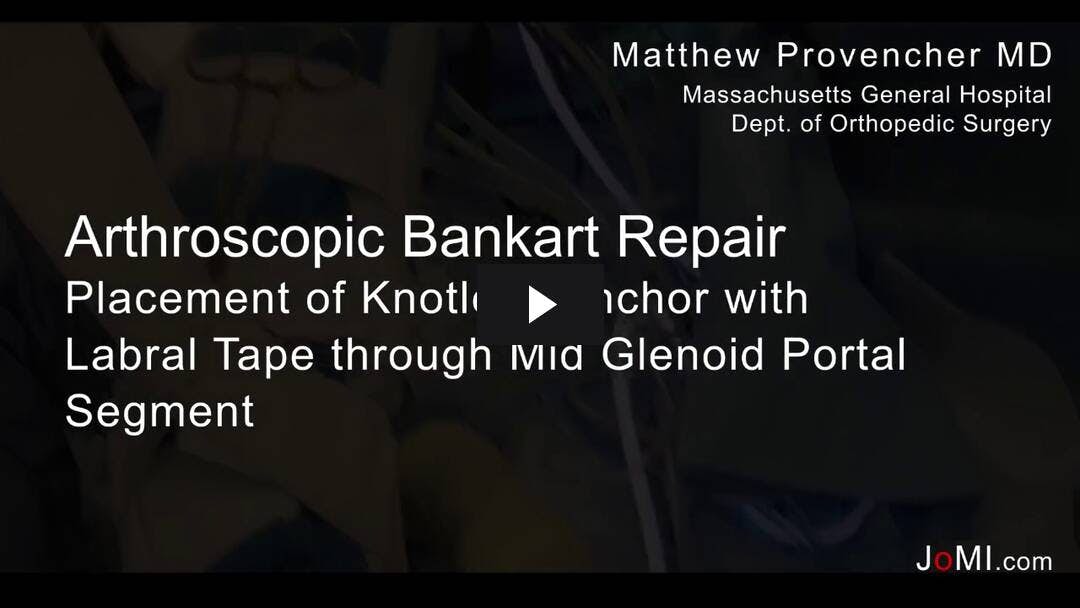 Video preload image for Placing Knotless Suture Anchor through Mid-Glenoid Portal
