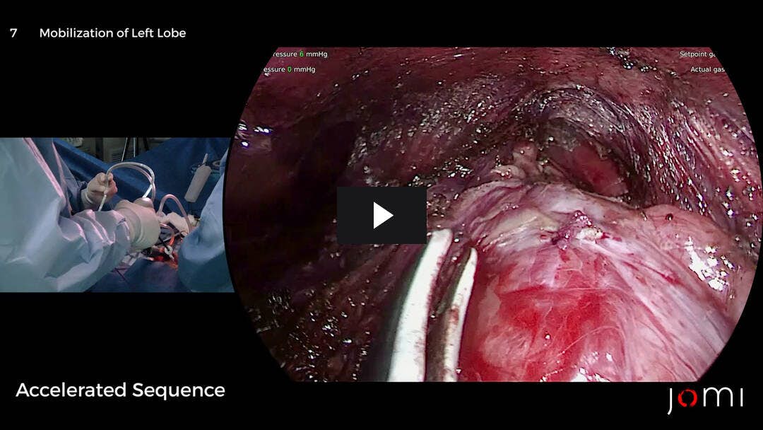 Video preload image for Trans-Oral Endoscopic Thyroidectomy Vestibular Approach (TOETVA)