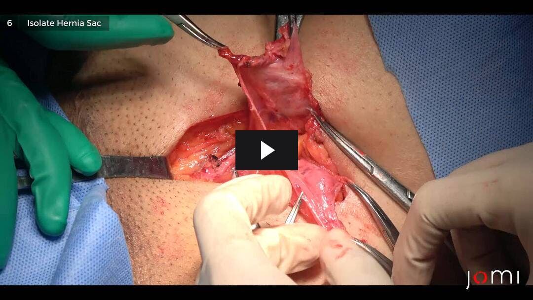 Video preload image for Left Indirect Inguinal Hernioplasty