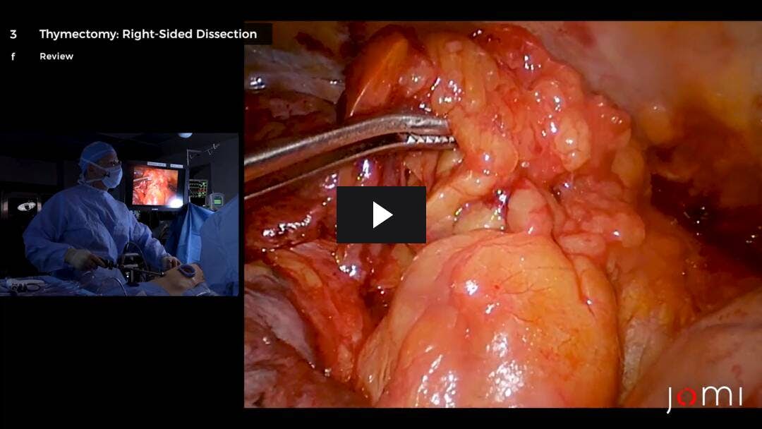 Video preload image for Timectomía combinada y resección en cuña pulmonar del lóbulo inferior derecho mediante toracoscopia