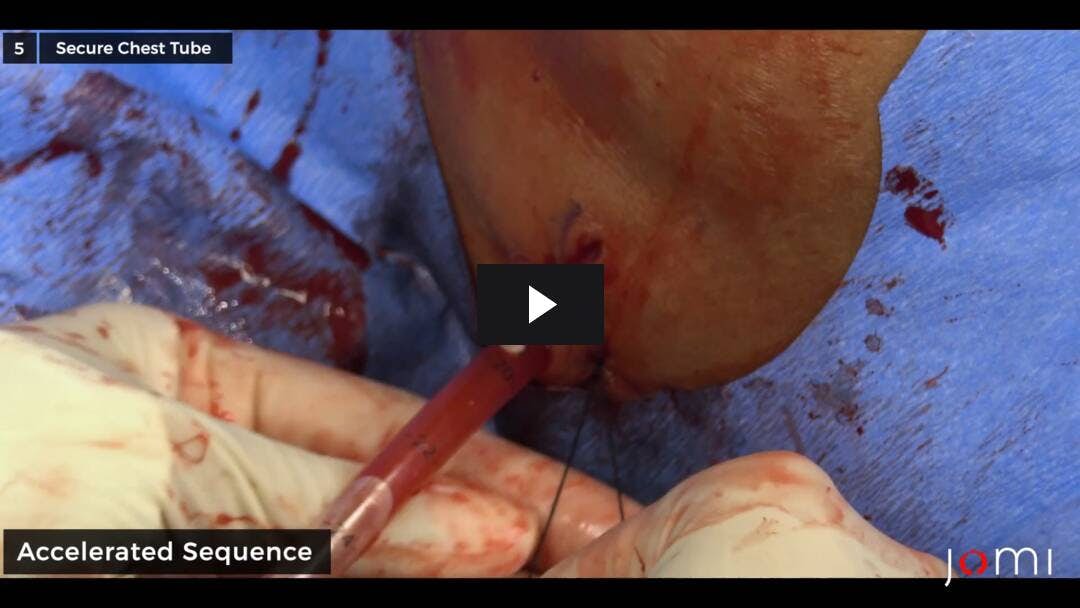 Video preload image for संभावित Hemothorax के लिए छाती ट्यूब प्लेसमेंट