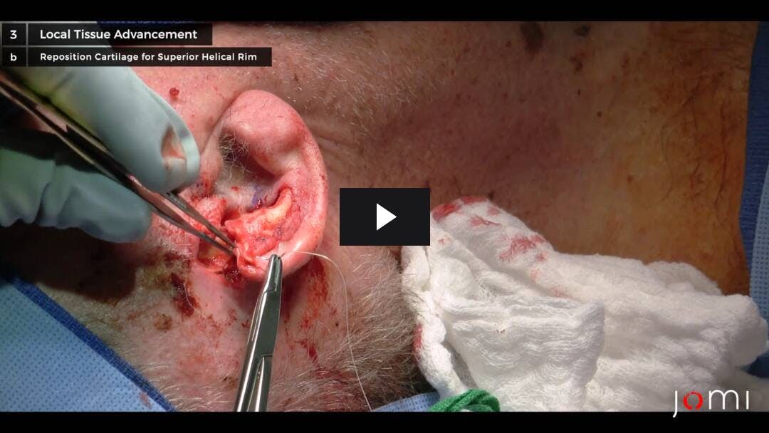 Video preload image for Local Tissue Advancement: Reconstructing Superior Helical Rim Defect and Exposed Ear Cartilage After Mohs Surgery