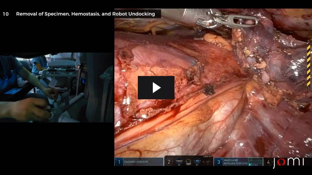 Video preload image for Robotic Thymectomy for Myasthenia Gravis