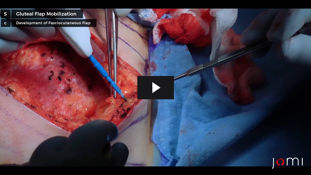 Video preload image for संशोधन Bascom फांक लिफ्ट Pilonidal Cystectomy