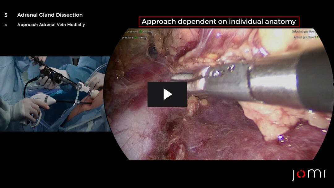 Video preload image for Adrenalectomía retroperitoneoscópica posterior derecha (PRA) para el adenoma adrenocortical