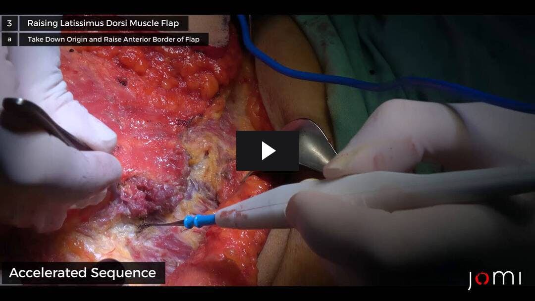 Video preload image for 왼쪽 유방 절제술 왼쪽 Latissimus Dorsi 근피 국소 피판이있는 상처 봉합