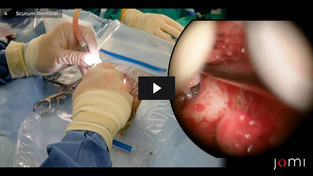 Video preload image for Stapedotomy (Endaural)