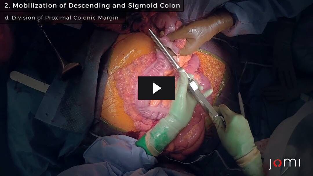 Video preload image for Colectomía izquierda abierta para el cáncer de colon: resección de colon izquierdo y sigmoide con formación de colostomía