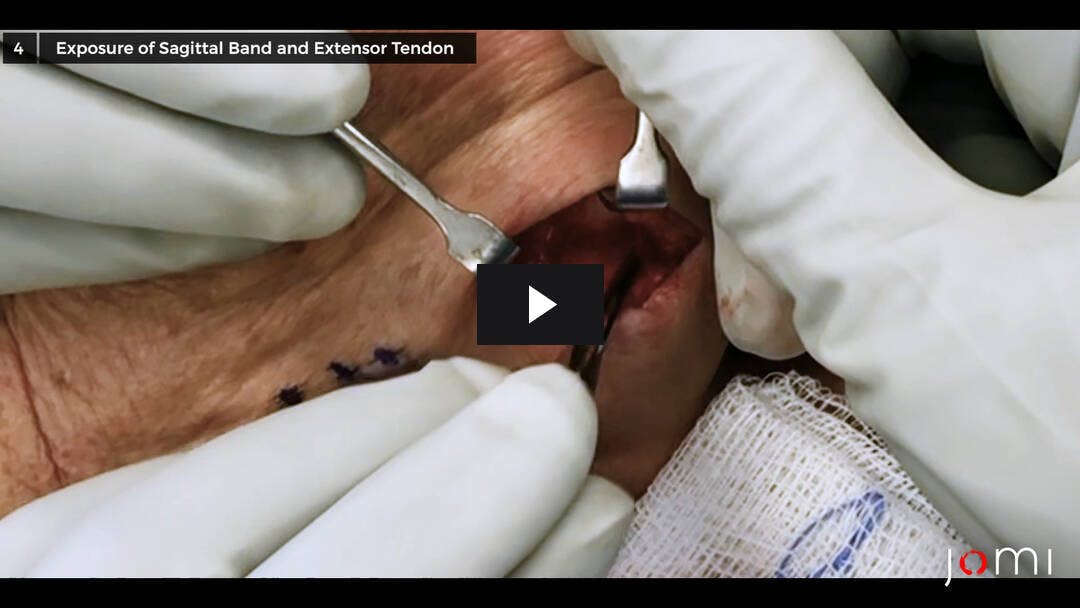 Video preload image for Repair of a Chronic Degenerative Sagittal Band Rupture of the Right Ring Finger
