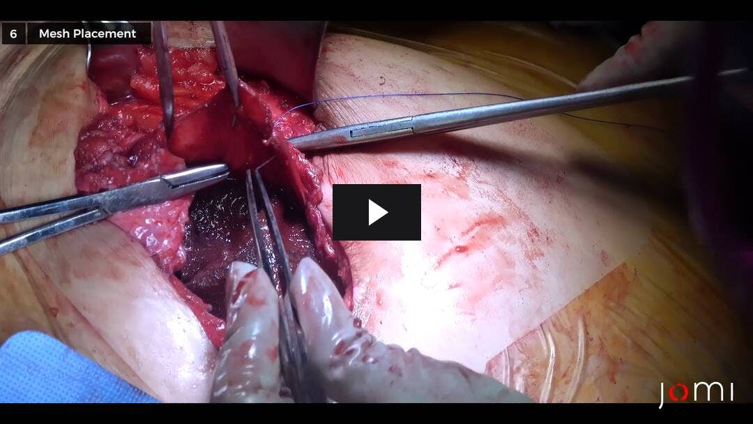 Video preload image for Intraperitoneal Mesh Repair for Incisional Hernia