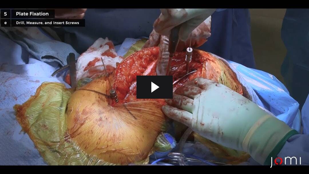 Video preload image for Reducción abierta y fijación interna de una fractura humeral periprotésica diafisaria
