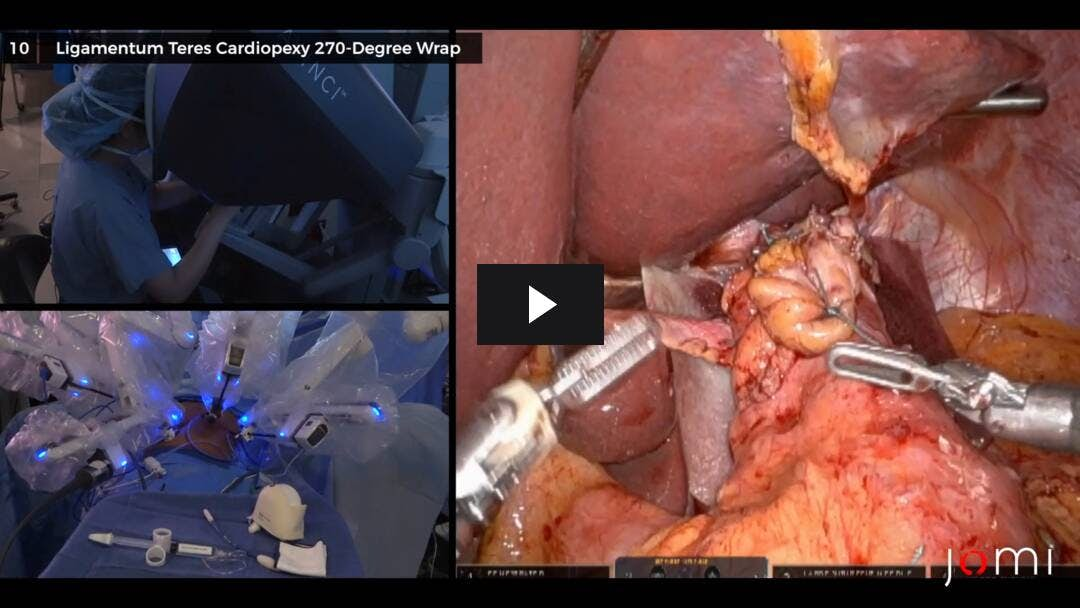 Video preload image for Robotic Ligamentum Teres Cardiopexy with Hiatal Hernia Repair for GERD following Longitudinal Sleeve Gastrectomy