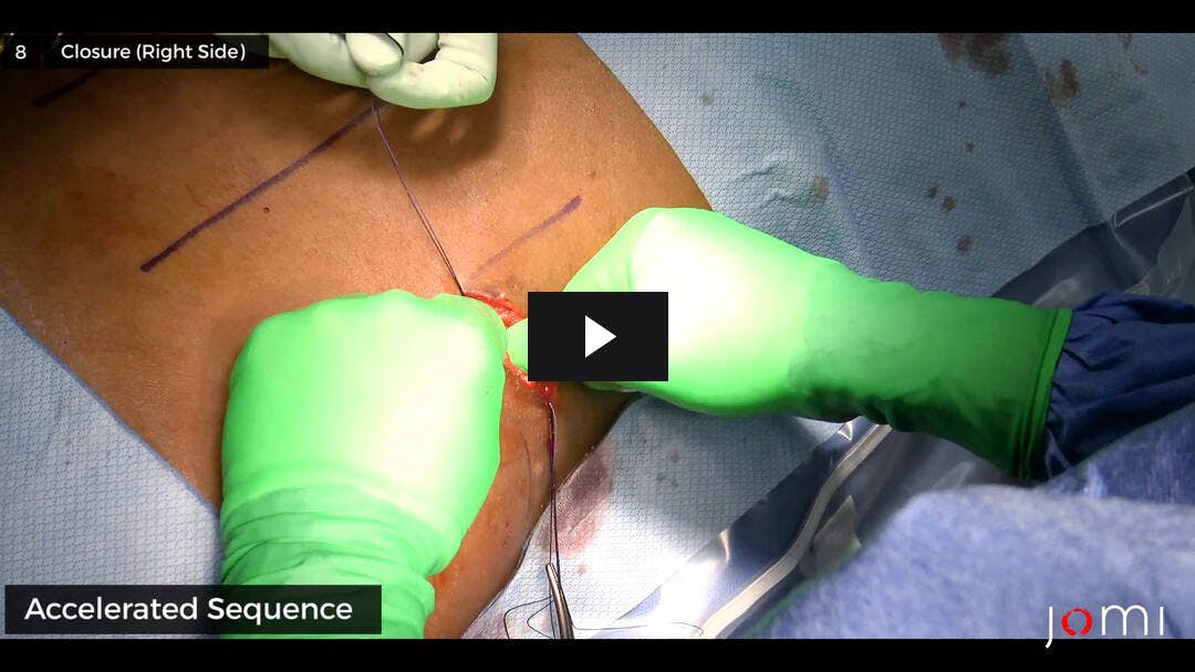 Video preload image for Bilaterale posteriore retroperitoneoskopische Adrenalektomie mit kortikaler Schonung auf der rechten Seite
