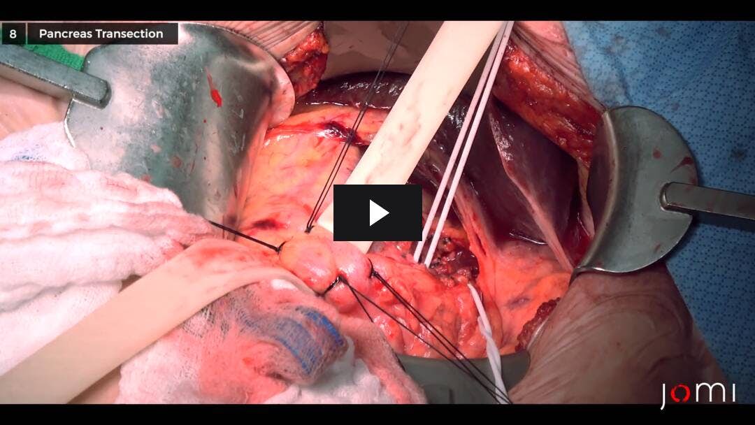 Video preload image for Open Distal Pancreatectomy for Pancreatic Cancer