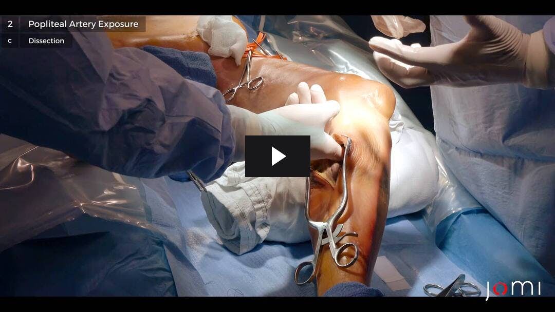 Video preload image for Bypass femoral a distal con conducto (cadáver)