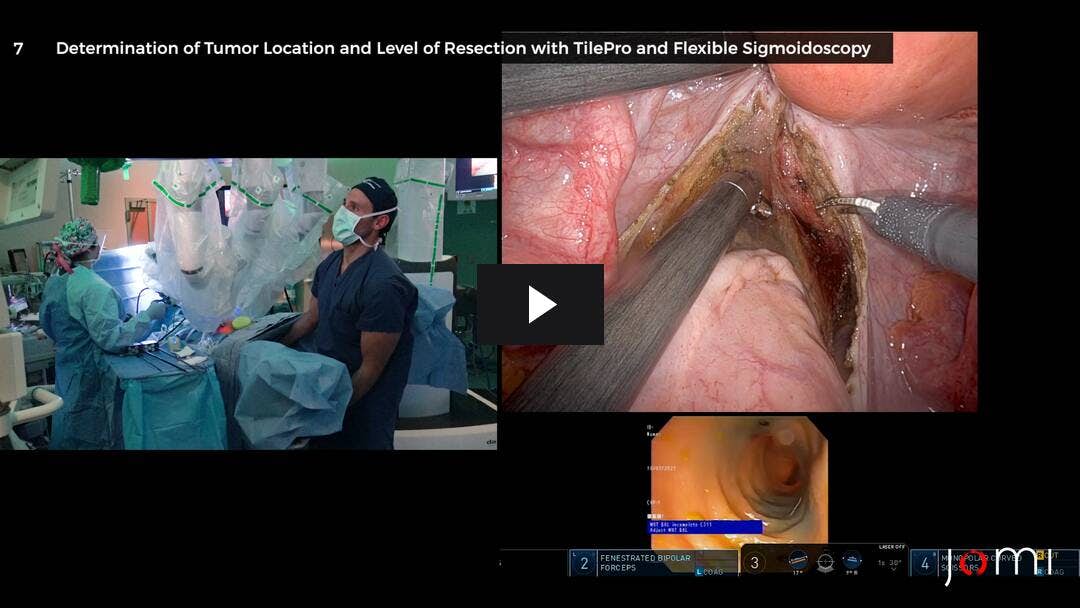 Video preload image for Robotic Low Anterior Resection with Diverting Loop Ileostomy for Locally Advanced Rectal Cancer