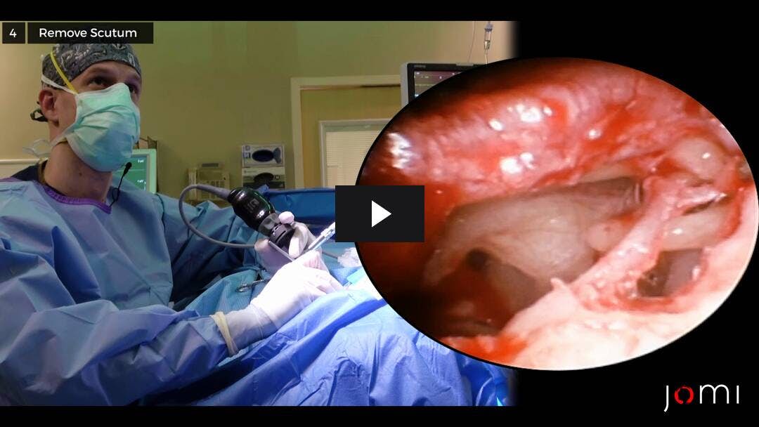 Video preload image for Endoscopic Stapedectomy