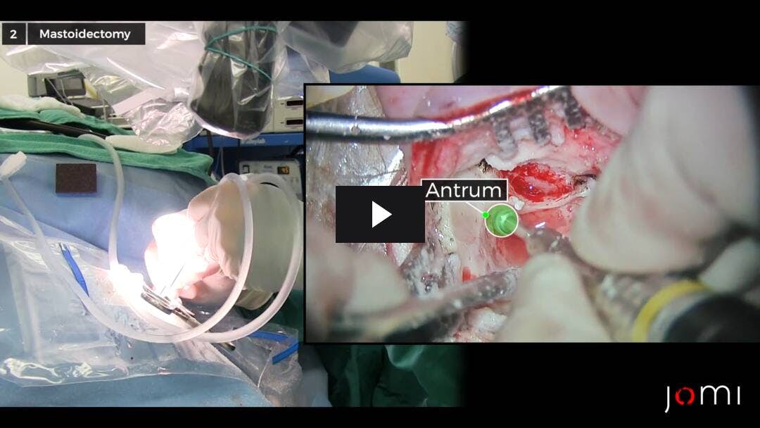 Video preload image for Mastoidectomy