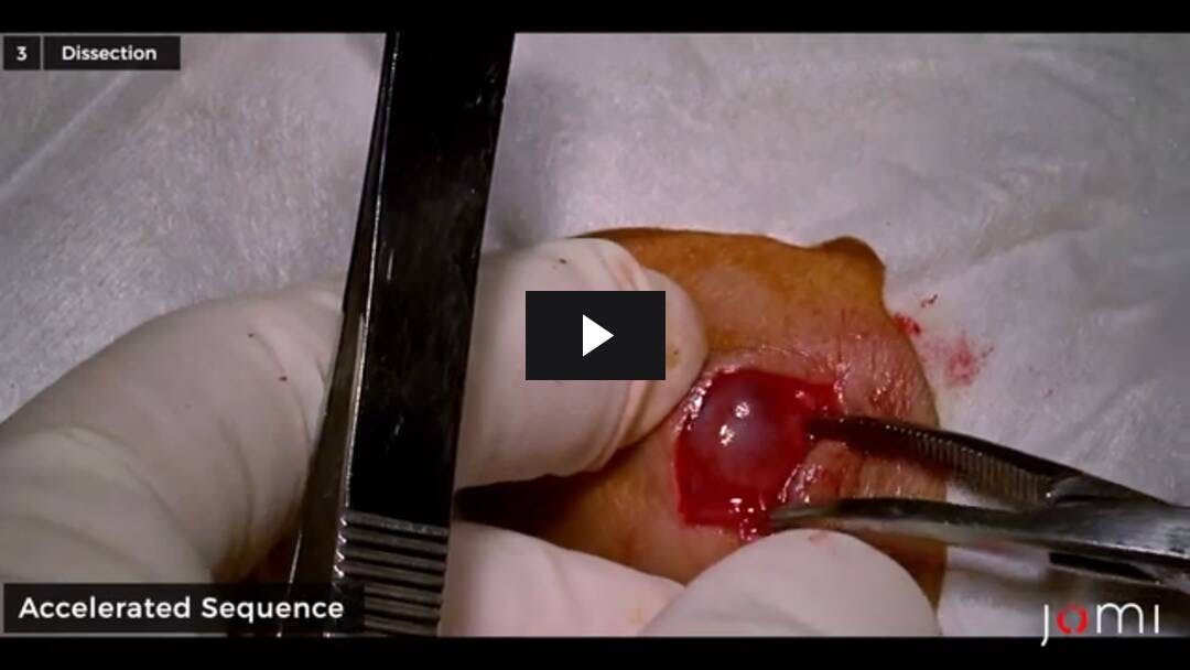 Video preload image for एक संसाधन-सीमित सेटिंग में एक कलाई नाड़ीग्रन्थि पुटी के बाल चिकित्सा सर्जिकल उपचार
