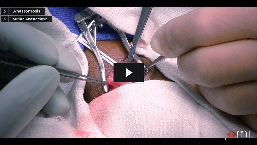 Video preload image for 방사형 - 두부 동정맥루 누공의 생성
