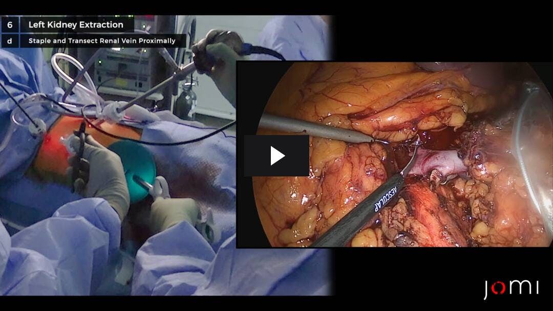 Video preload image for Nefrectomía laparoscópica izquierda del donante