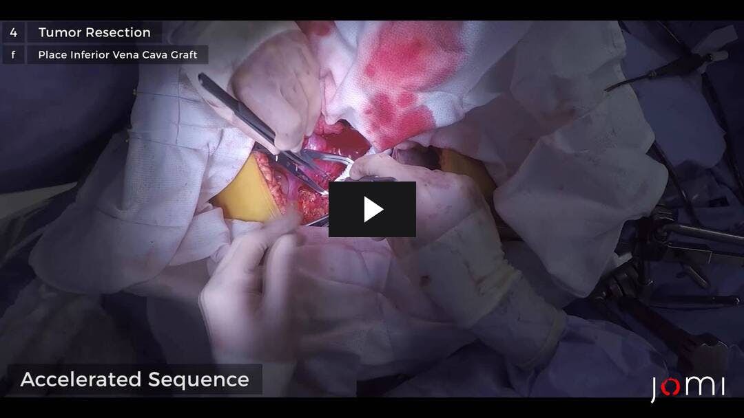 Video preload image for Leiomyosarcoma of Inferior Vena Cava: Resection and Reconstruction
