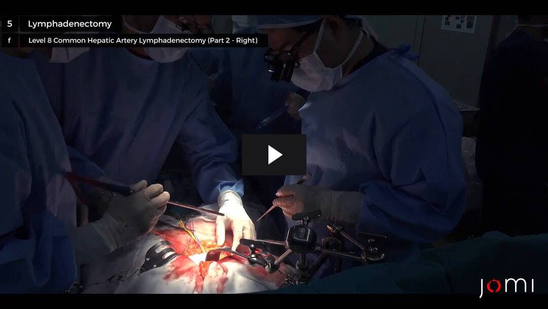 Video preload image for Open Radical Cholecystectomy with Partial Hepatectomy for Gallbladder Cancer