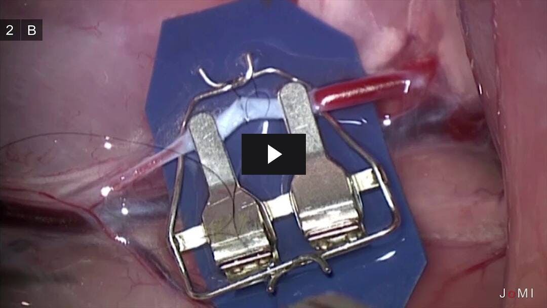Video preload image for Mikrochirurgische Technik für 1mm Gefäß End-to-End-Anastomose