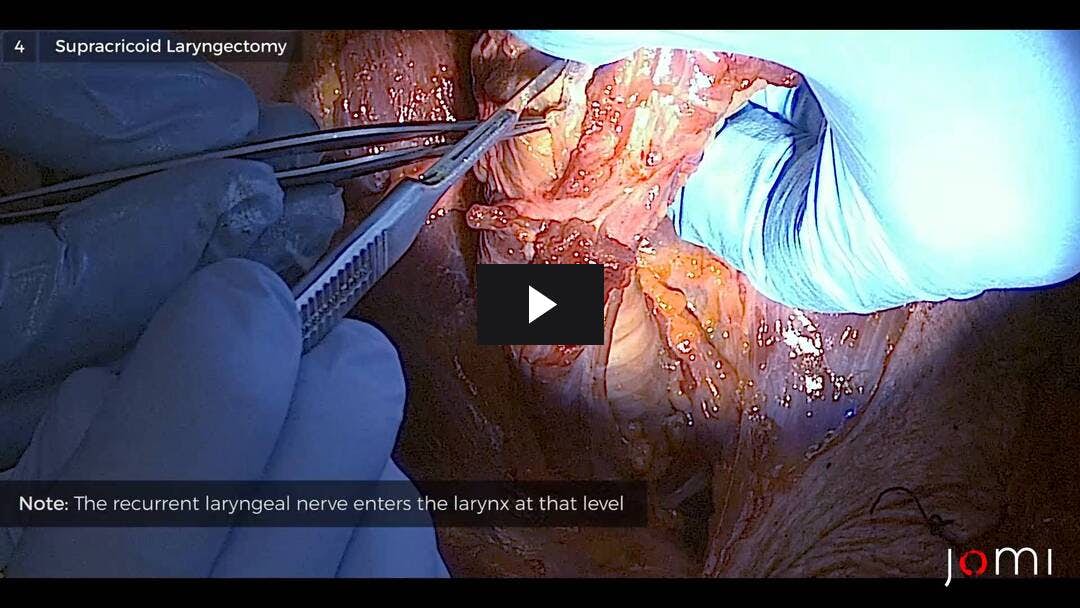 Video preload image for Partial Laryngectomy Techniques (Cadaver)