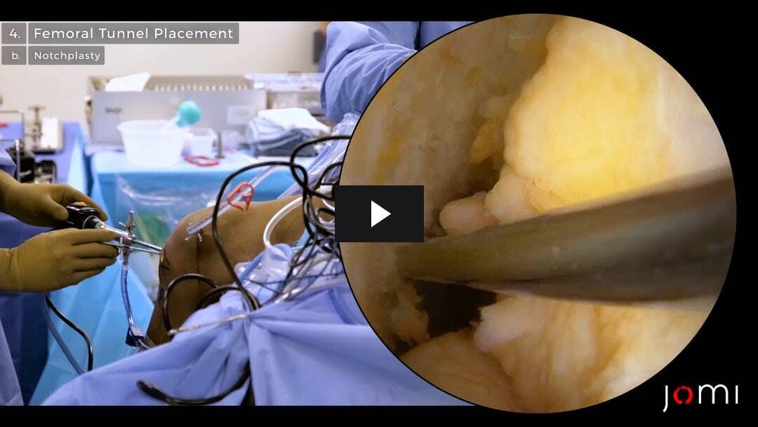Video preload image for 전내측 기술을 사용한 뼈 슬개골 이식편을 사용한 관절경 ACL 재건