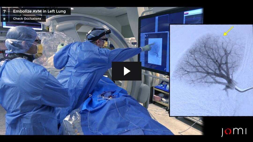 Video preload image for Embolización pulmonar de MAV