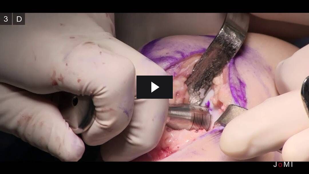 Video preload image for Osteochondritis Dissecans에 대한 Osteochondral Allograft를 사용한 대퇴골 재 포장