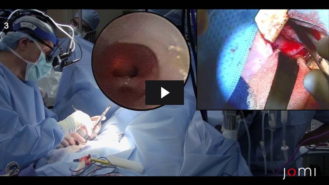 Video preload image for Aortopexia para la compresión de la arteria innominada de la tráquea