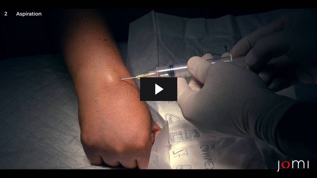 Video preload image for Aspiration of Ganglion Cyst on Right Wrist