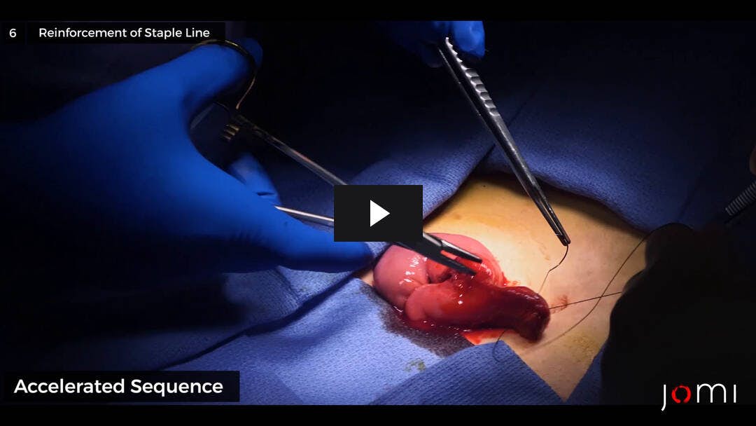Video preload image for Reversión de la ileostomía para una proctocolectomía laparoscópica de dos etapas con bolsa en J ileoanal para la colitis ulcerosa