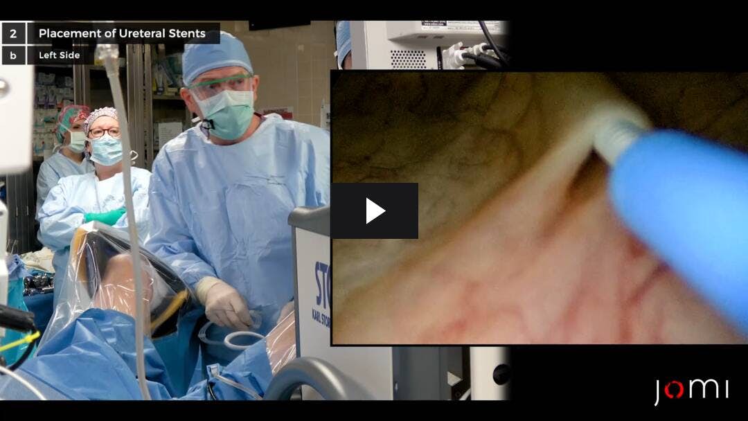 Video preload image for Cystoscopy and Placement of Ureteral Stents: Preoperative for HIPEC Surgery